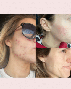 acne diet, acne treatment